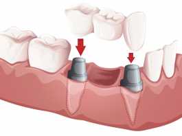 implantati za zube