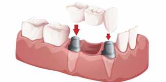 implantati za zube