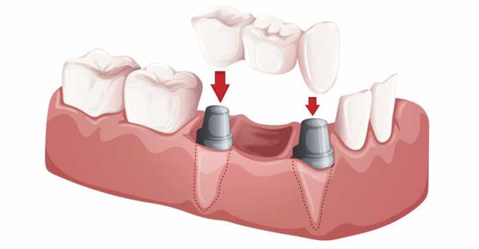 implantati za zube